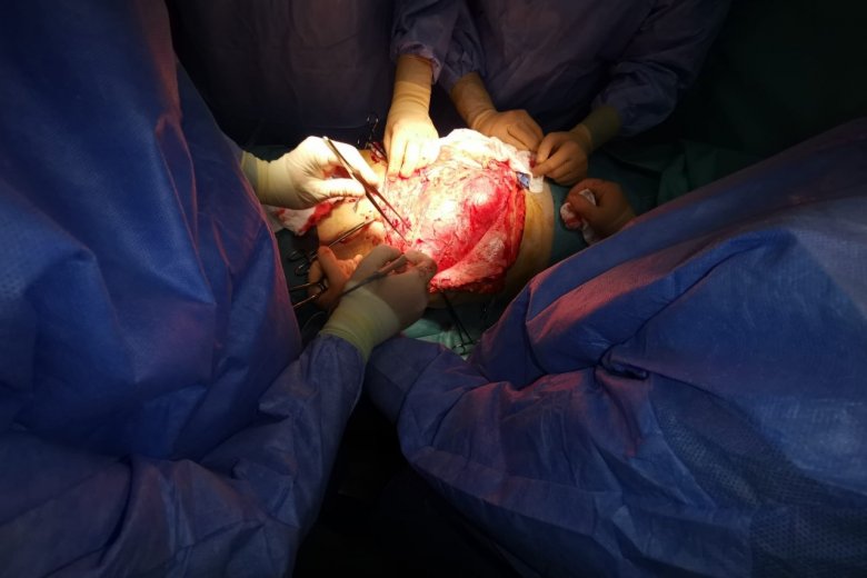 Hatalmas tumort távolítottak el egy páciens hasüregéből Marosvásárhelyen