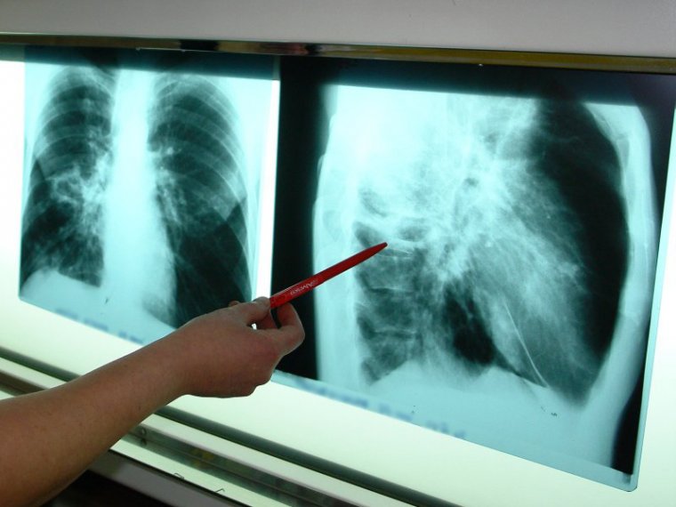 Ha Maros megyében él, itt a lehetőség, hogy ingyenes tüdővizsgálaton vegyen részt