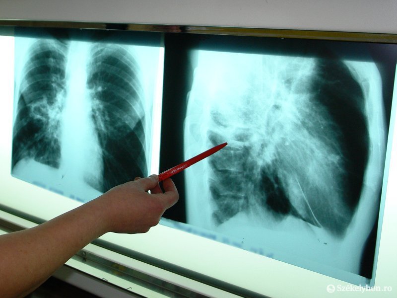 Díjmentes tbc-vizsgálatok a fertőzöttek kiszűréséért