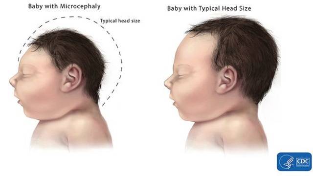 Zika-vírus: megszületett az első kórosan kisfejű európai csecsemő
