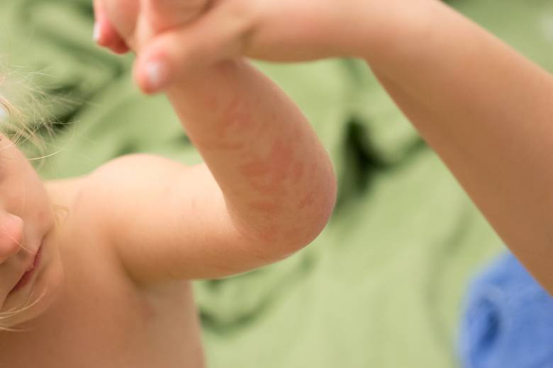 baba ekcéma gyakori kérdések hogyan lehet hatékonyan kezelni a pikkelysömör népi gyógymódokkal