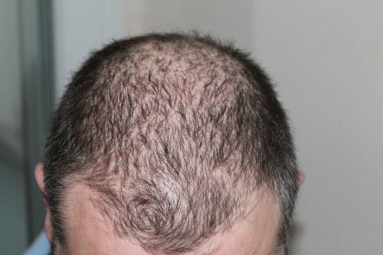 Felcsúszik a homlok, kilátszik a fejbőr: betegség is állhat a hajhullás hátterében